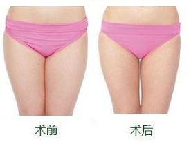 南京是如何减掉臀部肌肉的?