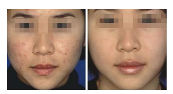 面部的痘痘真的可以通过激光祛除吗?