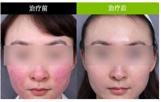 �Ͼ�����ȥ��Ѫ˿Ч������