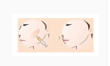 自体脂肪填充苹果肌多长时间恢复?