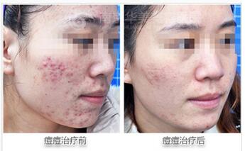 南京做激光祛痘的过程痛吗?